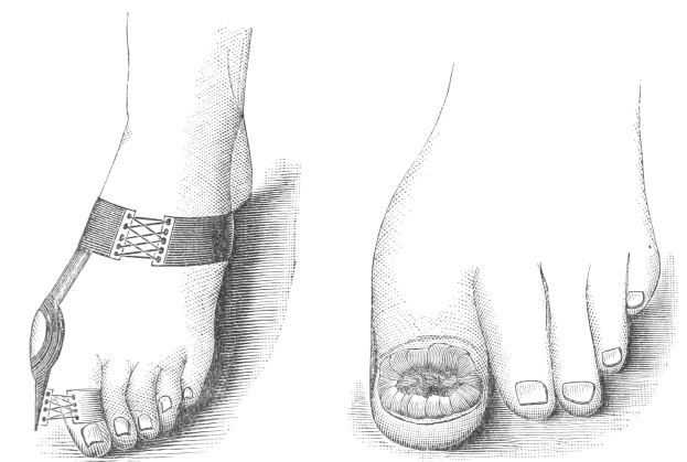 Schwarze und weiße Zeichnung von zwei Füßen, einer mit einem Verband und der andere mit einer Fraktur, mit Text zur Behandlung.