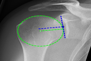 Ein Röntgenbild einer Schulter mit einem grünen Kreis, der ein Ligament in der Mitte markiert, umgeben von anderen Ligamenten.