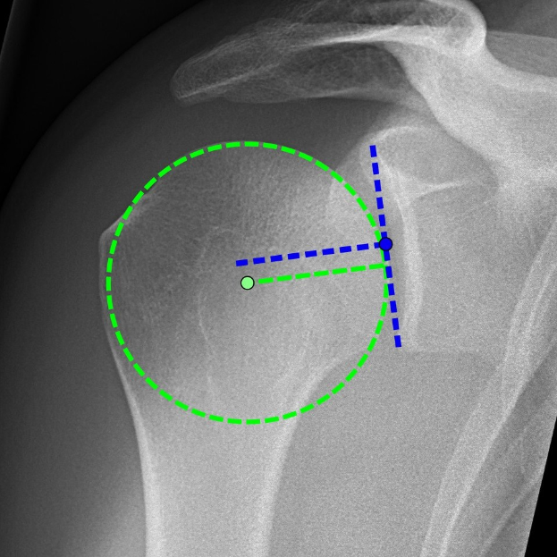 Ein Röntgenbild einer Schulter mit einem grünen Kreis, der ein Ligament in der Mitte markiert, umgeben von anderen Ligamenten.