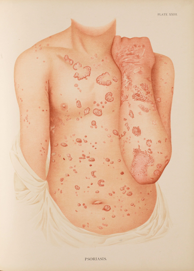 Buchumschlag mit einer medizinischen Illustration eines Männerkörpers mit roten Flecken, die wahrscheinlich Psoriasis darstellen, mit begleitendem Text zum Thema.
