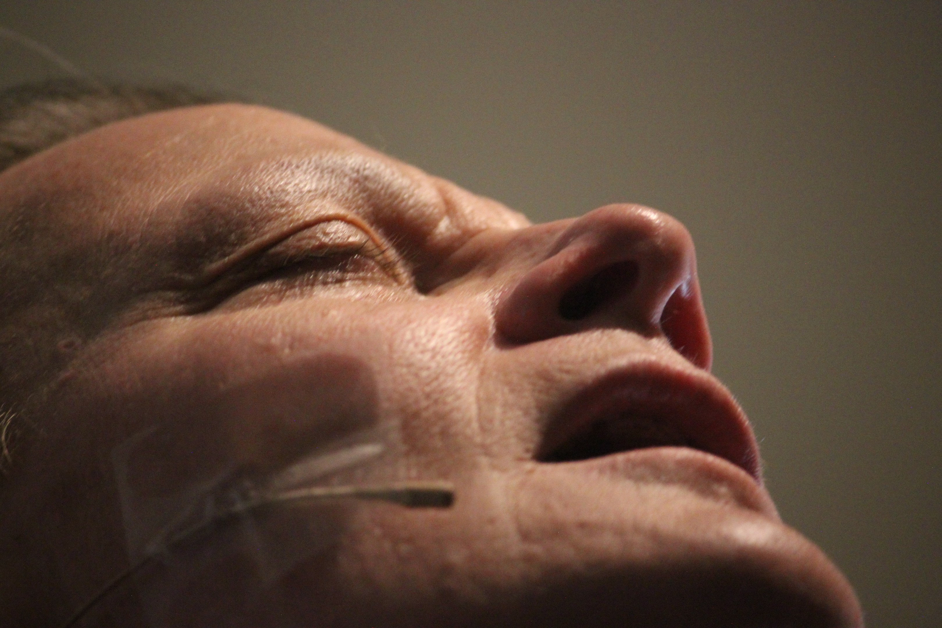 Nahaufnahme eines Frauengesichts während einer Behandlung mit Nadeln in der Nase, Augen geschlossen, vor einer leeren Wand.